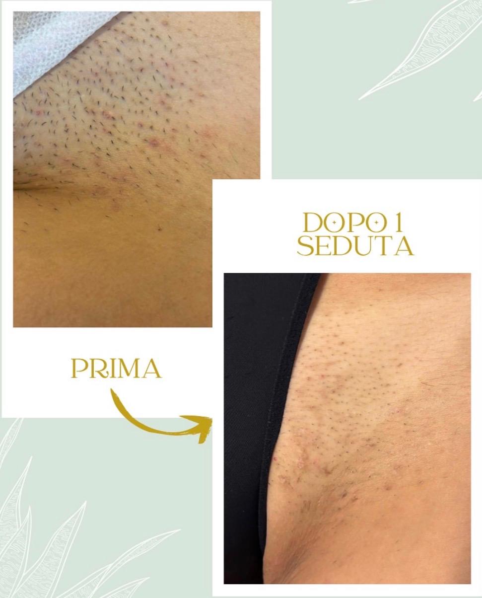 Prima e dopo un ciclo di sedute